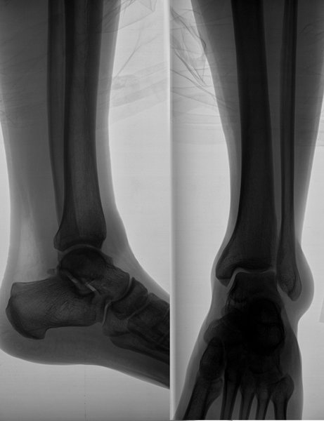 x rays