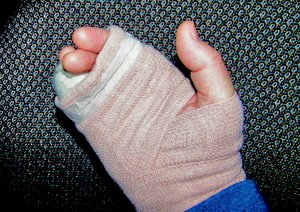 Broken Hand: A hand with the outside knuckles broken off. It is shown temporarily wrapped before the surgery to have pins installed, This is called a boxer's break.